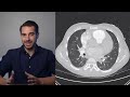 What is Pneumonia - Symptoms, Causes, Types