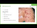 Bacterial Meningitis (CNS Infection) – Infectious Diseases | Lecturio