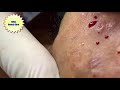 Acne clear - Blackhead removal - Beauty care video #26