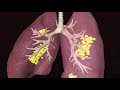 How The Coronavirus Attacks Your Lungs | Deep Look