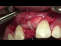 CV-85 Anterior Implant Placement with Simultaneous GBR using... PREVIEW