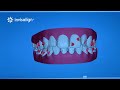 Invisalign | Treatment Steps | Orthodontic Video Production