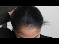 Hair Transplant for Black Women - Female Hair Transplant Results for Hair Loss