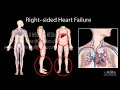 Congestive Heart Failure: Left-sided vs Right-sided, Systolic vs Diastolic, Animation.