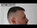 FUE Hair Transplant Timeline I Day 1 to Day 365 I Before & After
