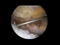 Surgery Video Shoulder