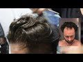 Hair Transplant Results with 4000 Grafts - Before and After (HLC Turkey)