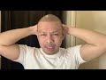 30 DAYS POST OP 2000 grafts | FUE HAIR TRANSPLANT IN THE PHILIPPINES