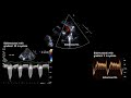 Assessment of neonatal hypertension by echocardiography