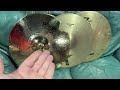 Someone welded this cymbal.