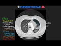 What is a Pneumothorax? EXPLAINED!