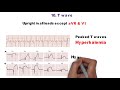 HOW TO READ AN ECG!! WITH ANIMATIONS(in 10 mins)!!