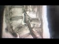 Spondylolisthesis grade 2-3