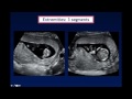 AIUM Webinar: Systematic Evaluation of the 11-14 Week Fetus, Touching on ISUOG Guidelines