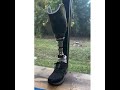 The BK pin lock prosthesis paired with the Ossur Proflex XC foot. Experience sta