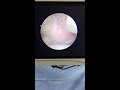 Treating Ankle Sprain: Arthroscopy & Plica Excision Technique | Dr. Sarang Desai