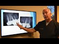Updated Information on Root Canals and Treatments by Dr Dana Rockey