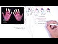 Systemic Lupus Erythematosus (SLE) - signs and symptoms, pathophysiology, investigations, treatment