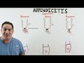 Appendicitis | Clinical Medicine