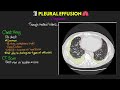 What is a Pleural Effusion? EXPLAINED!