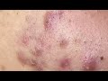 Blackheads And Pimples | Điều Trị Mụn Tuổi Dậy Thì - SacDepSpa #349