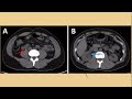 Nephrolithiasis (Kidney Stones) - CRASH! Medical Review Series