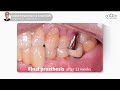 Implant placement with small GBR by Wide Cover Cap - [Dr. Jeon Inseong]