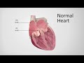 Normal Heart vs. Heart in AFib
