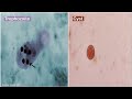 Entamoeba histolytica life cycle | morphology | Laboratory diagnosis | Picmonic QUIZ