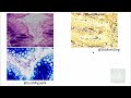 H Pylori Gastritis : Epidemiology, Pathogenesis, Clinical features, Sequelae & Treatment
