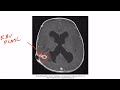 Epstein-Barr Virus for the USMLE Step 1