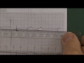 12 Lead EKG (ECG) STEMI examples
