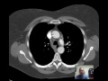 CT Chest Lung Nodule Discussed by Radiologist