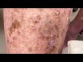 Skin Peeling (Seborrheic Keratosis) | CONTOUR DERMATOLOGY