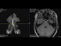 Basilar artery fenestration