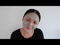 How I cleared acne rosacea without medication | Skincare storytime & simple routine