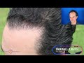 Plan on having two Surgeries - Steve Talks about Expectations and Hair Transplant Results