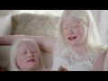 This Couple Adopted Four Children With Albinism | Born with Albinism