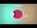 Eye defects - Myopia | Don't Memorise