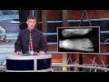 Injury Report - Turf Toe with Orthopedic Surgeon Dr. Steven Michelsen