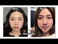MY PLASTIC SURGERY TRIP TO KOREA Part 2 (Facial contour, Rhinoplasty & Double eyelid surgery)