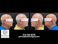 Neck Lift Austin Texas ( Neck Lift for Men)