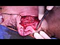 Superficial parotidectomy