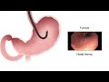 HCC 1475-4 -  Stomach - Pathology Endoscopy Findings