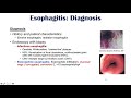 Esophagitis (Esophagus Inflammation): Causes, Risk Factors, Signs and Symptoms, Diagnosis, Treatment