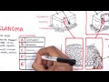 Melanoma - Overview (signs and symptoms, pathology, risk factors, treatment)