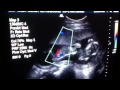 twin ultrasound at 16 weeks