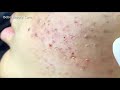 Acne Clear   Blackheads Removal   Beauty Care Video