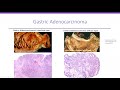 Part 5- Pathology of Gastric Disorders-  polyps and Tumors