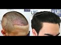 FUE Hair Transplant (1531 Grafts NW III A) By Dr Juan Couto - FUEXPERT CLINIC, Madrid, Spain